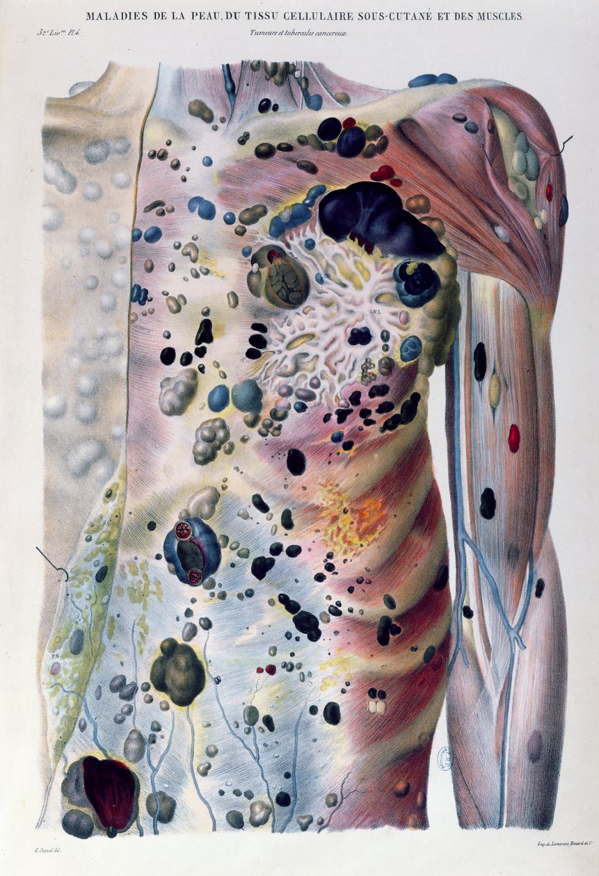 Tumore und krebsartige Tuberkel, aus 