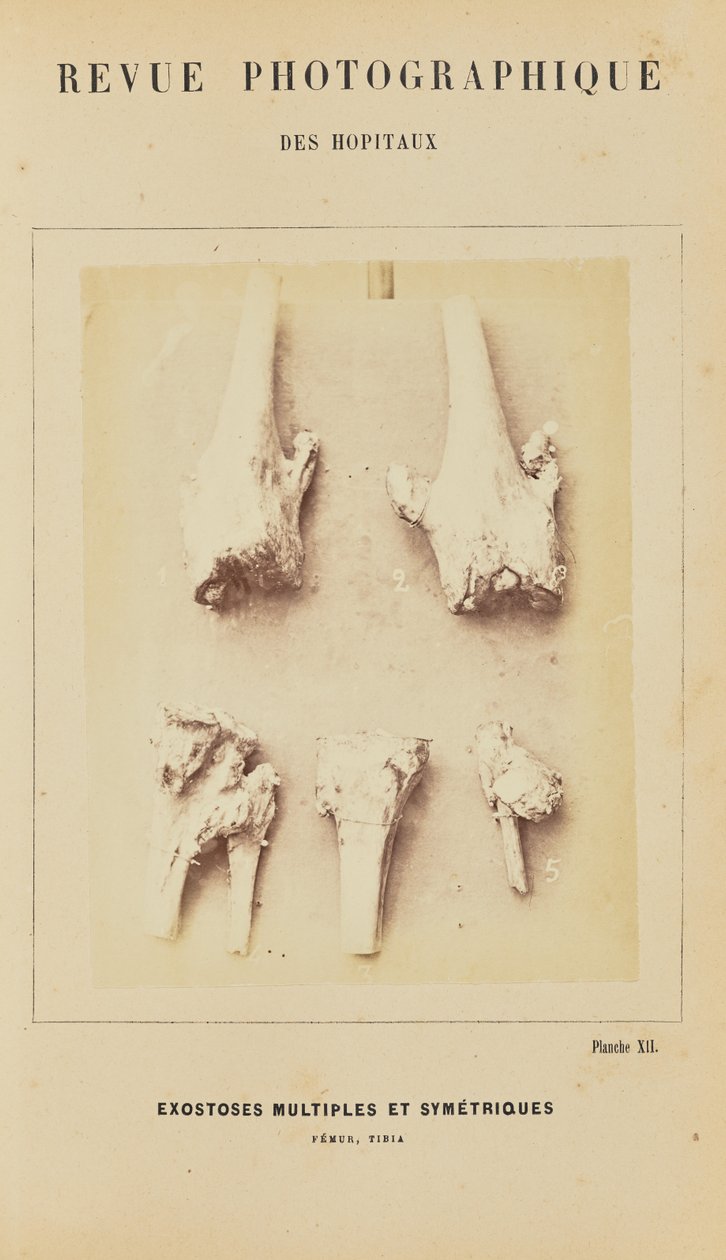 Mehrfache und symmetrische Exostosen, Femur, Tibia von Arthur de Montmeja