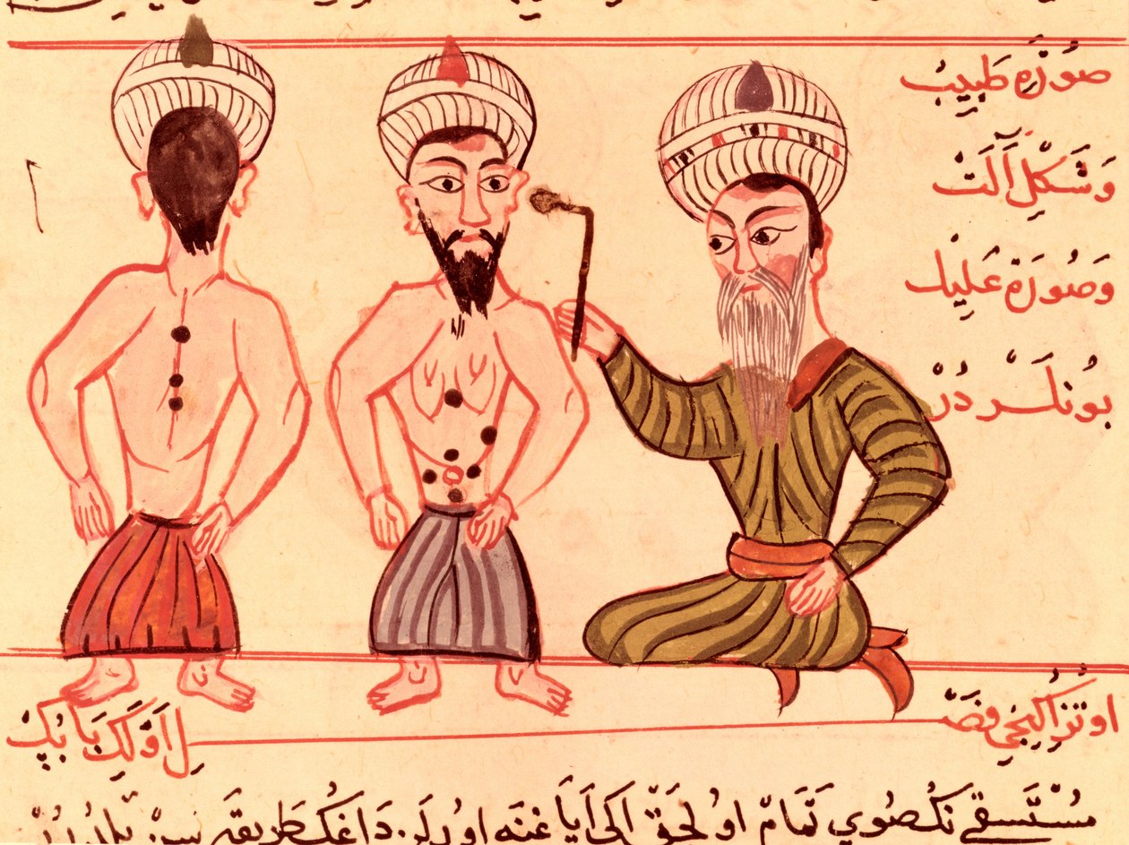 Ms Sup Turc 693 fol.35 Operation zur Kauterisation, 1466 von Charaf ed Din