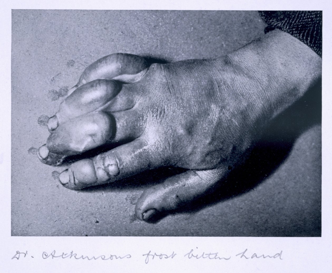 Dr. Atkinsons erfrorene Hand, 1911 von Herbert Ponting