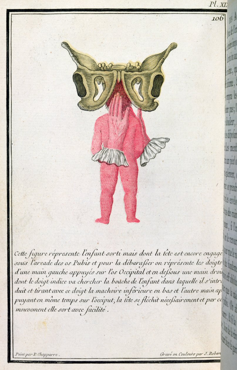 Querschnittsdiagramm eines aus dem Mutterleib gezogenen Babys, aus einem Buch von Madame Angelique Le Boursier du Coudray, graviert von J. Robert, 1783 von P. Chapparre