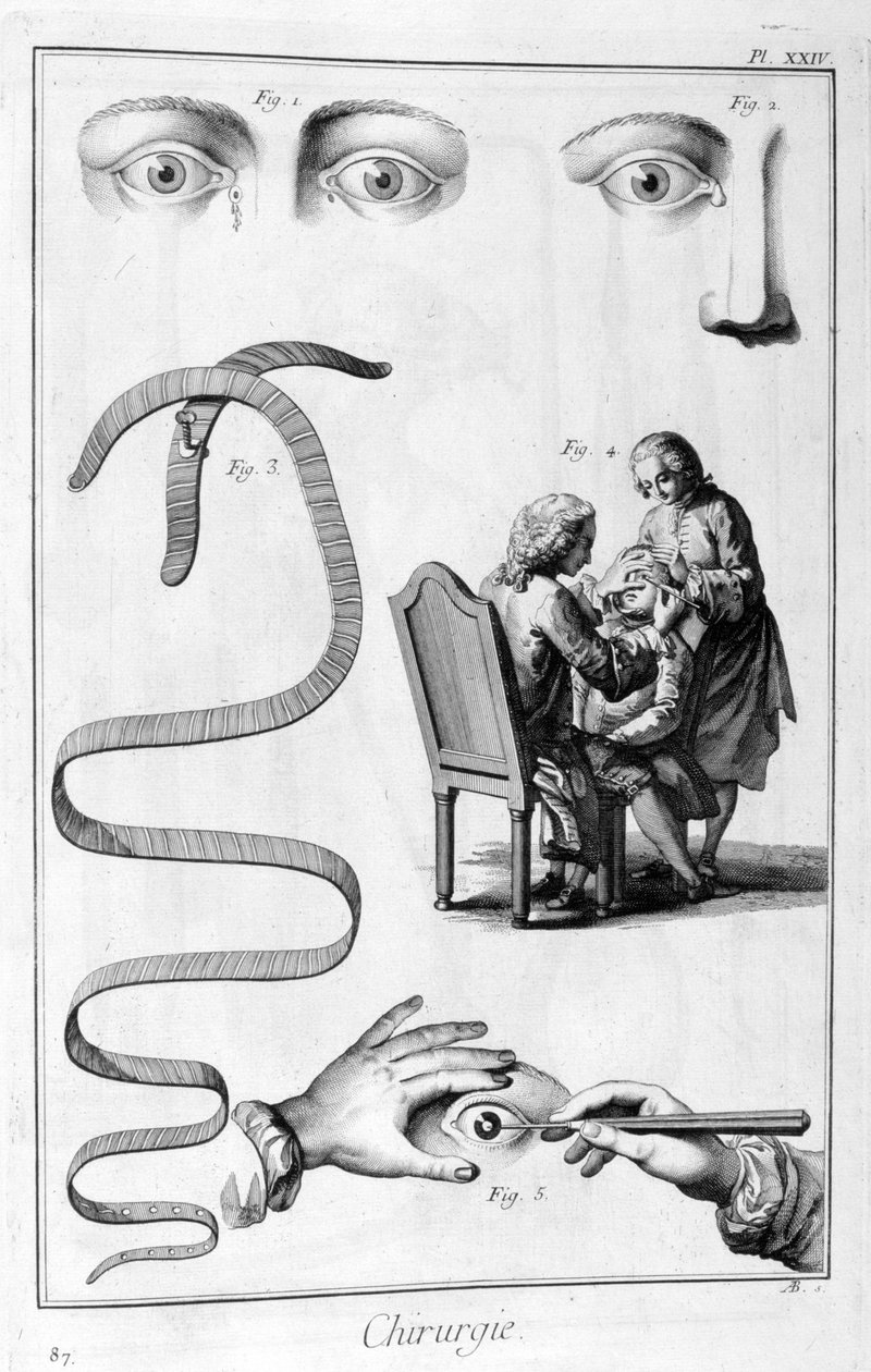 Augenoperation, 1751-1777 von Unbekannt