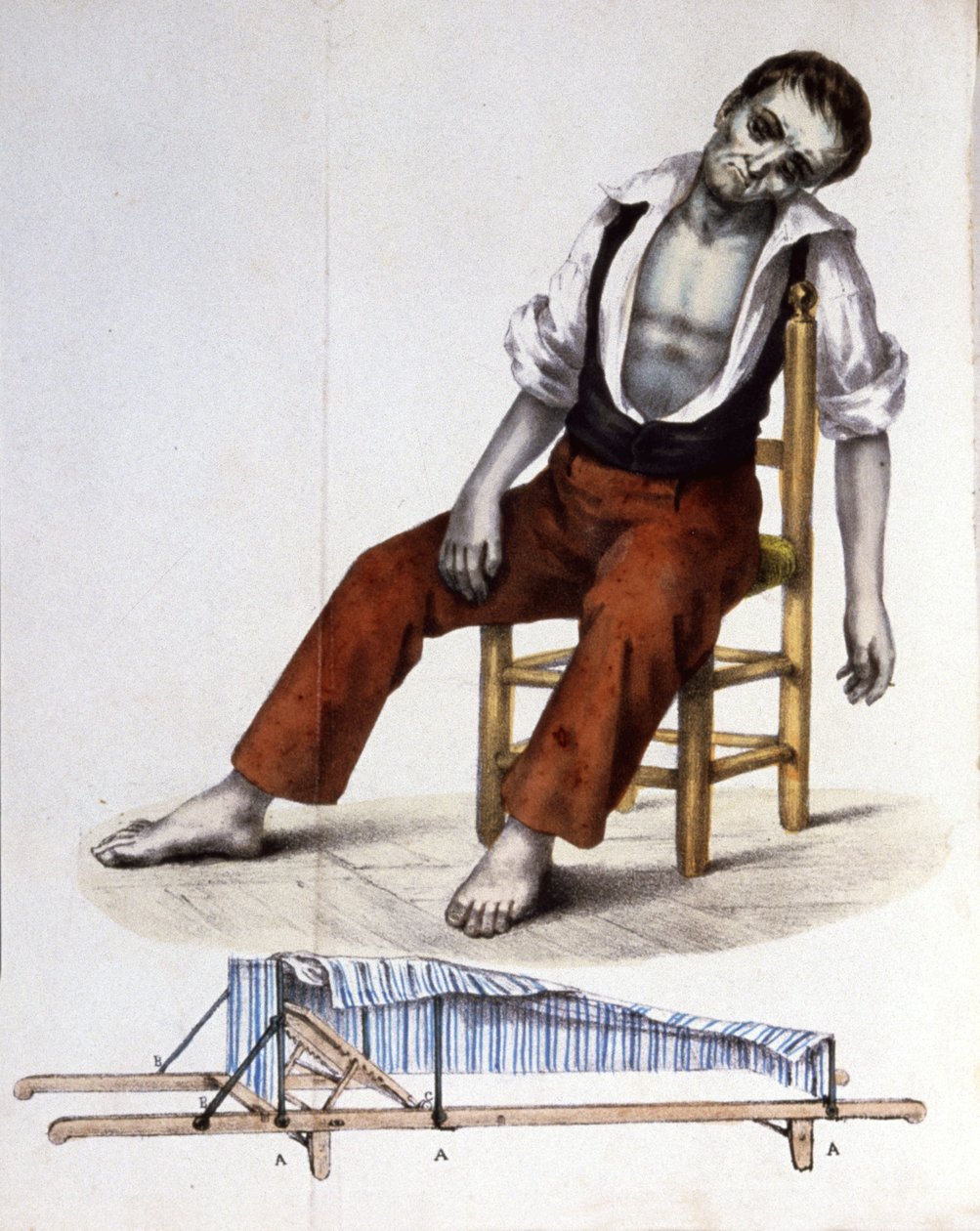 Patient mit Cholera von Unbekannter Künstler