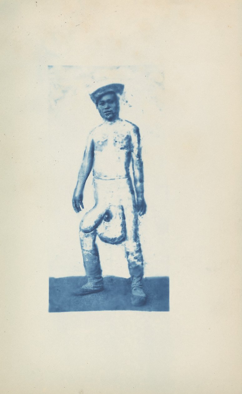 Elephantiasis, ca. 1870er Jahre (Foto) von Unknown photographer