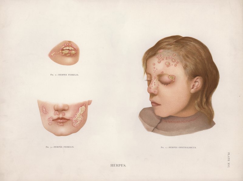 Hautkrankheiten: Herpes von English School